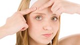 Tại sao một số người hay bị mụn?