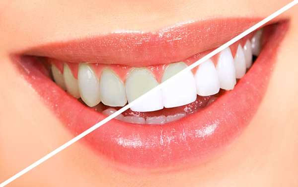15 Cách làm trắng răng tại nhà nhanh nhất từ nguyên liệu dễ kiếm rẻ tiền