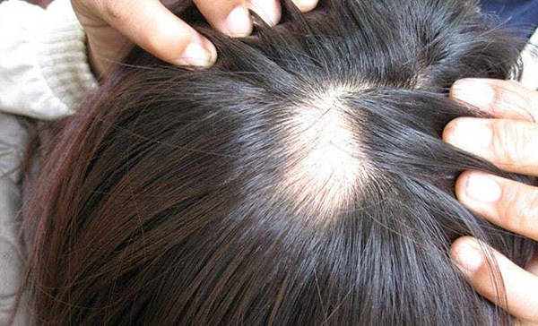Thuốc nào trị chứng rụng tóc hói đầu