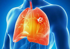 Những số liệu kinh hoàng về ung thư phổi