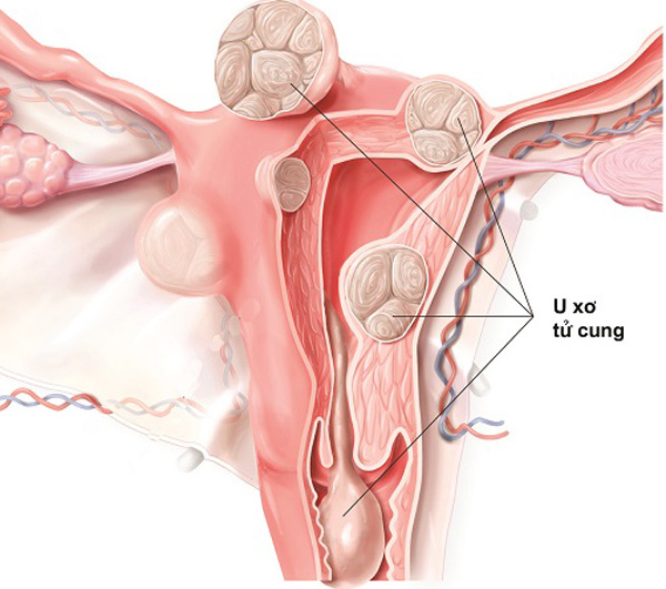 5 dấu hiệu bệnh phụ khoa nguy hiểm