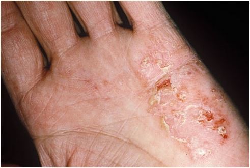 Chàm khô là tình trạng viêm da do da quá khô và nứt nẻ, thường là do dị ứng và cơ địa.