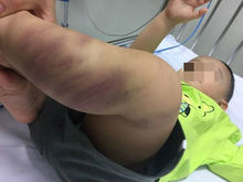 Hà Nội: Khởi tố vụ bé trai bị đánh đập, bỏ lại bệnh viện