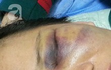 Hà Nội: Chồng đánh vợ vào vùng kín