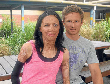 tình yêu, tình yêu đẹp, Australia, Turia Pitt, Michael Hoskin