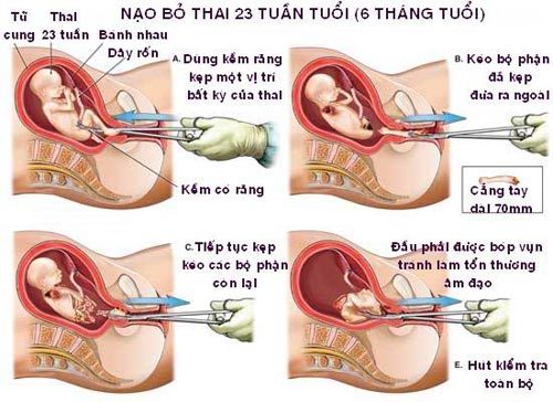 nạo phá thai, sức khỏe sinh sản
