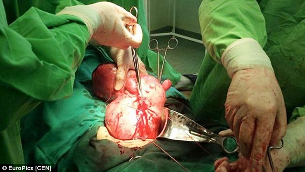 Ngỡ đang mang thai hóa ra là khối u khổng lồ