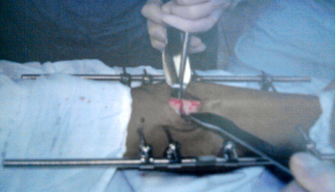 Cải thiện chiều cao để... giữ tình yêu