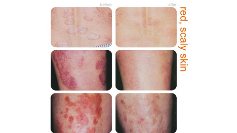 Kết hợp Đông-Tây y trong hỗ trợ điều trị mề đay