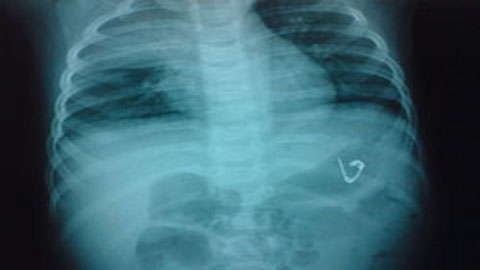 Mẹ sơ ý, con nuốt phải kim băng