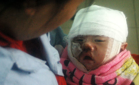 Mẹ sơ ý, con bị bỏng nặng