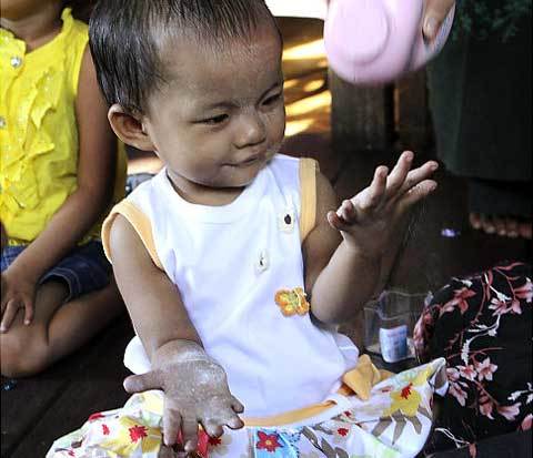 Kỳ lạ bé gái có 12 ngón tay, 14 ngón chân