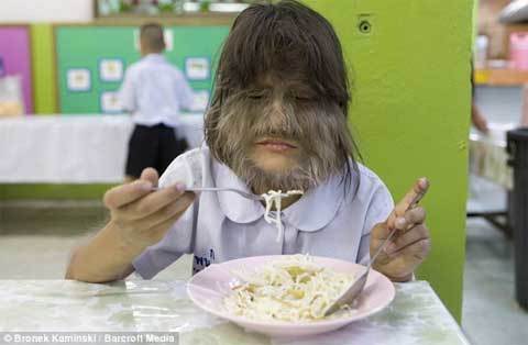 Chân dung cô bé nhiều lông nhất thế giới