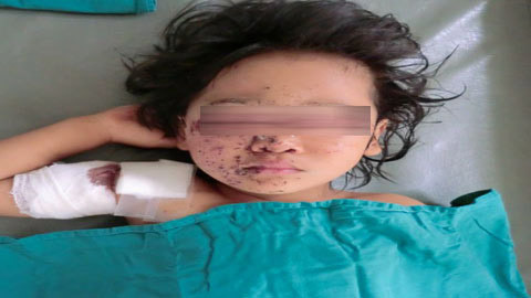 Bé gái bị hỏng đôi mắt vì thuốc nổ
