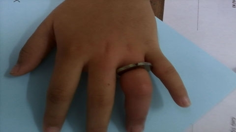 Bé gái suýt mất ngón tay vì đeo nhẫn