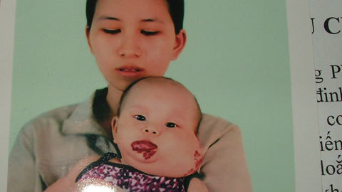 Đau đớn u máu trên mặt trẻ 3 tuổi