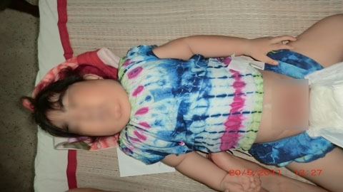 Thương tâm bé không có bộ phận sinh dục