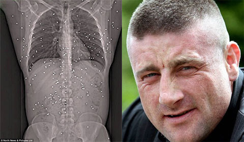 Sống sót thần kỳ với 150 viên đạn trong người