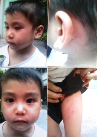 Bé 5 tuổi bị dì đánh đập và bỏ đói