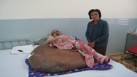 Ước mơ của bệnh nhân mang khối u 80 kg