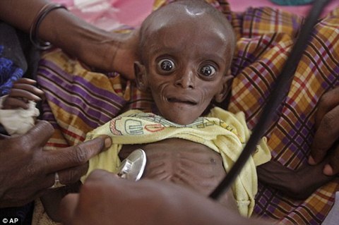 Somalia: Trẻ em tong teo vì đói