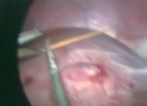 Uống nước, nuốt que tăm nhọn vào bụng