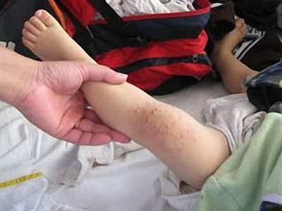 Bệnh nhi tử vong vì mắc tay chân miệng thể nặng