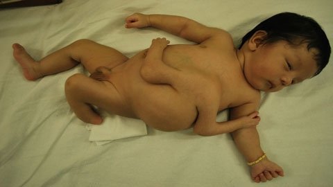 Bé sơ sinh có 4 cánh tay đã được phẫu thuật