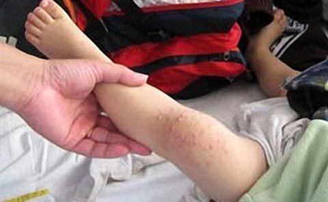 Bộ trưởng Y tế 'sốt ruột' với dịch tay chân miệng