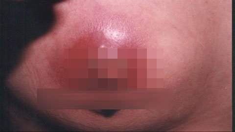 Nâng ngực dạo, silicon 'lổn nhổn' trên cơ thể