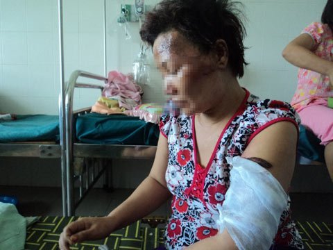 Đốt vợ bỏng mặt vì ghen tuông