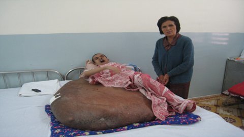 Sắp  phẫu thuật cho người có khối u hơn 80 kg