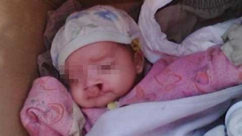 Bé sơ sinh hở hàm ếch bị vứt bên đường