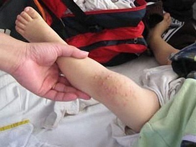 Ngành y tế lúng túng trước dịch tay chân miệng?