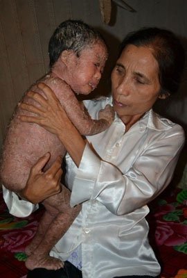 Tội tình đứa trẻ bị bong tróc toàn thân