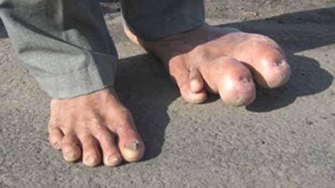 Nỗi tủi phận của người có bàn chân khổng lồ