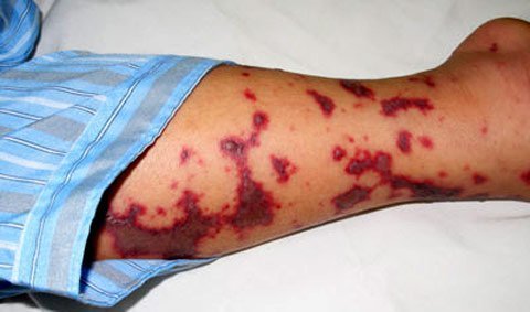 Dịp Tết, cảnh giác cao với viêm não mô cầu