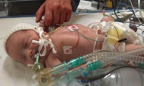 Bé sơ sinh không có máu sống sót kỳ diệu