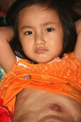 Nỗi đau cháu bé có “hậu môn” trên bụng