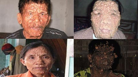 Hoảng hồn với những bệnh lạ ở Việt Nam