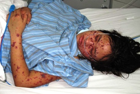 Hà Nội: 4 trẻ tử vong vì viêm màng não mô cầu