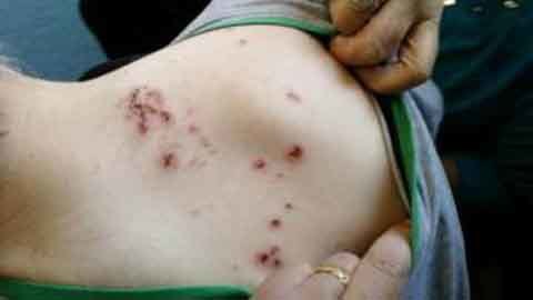 Bị chuột tấn công khi nằm viện