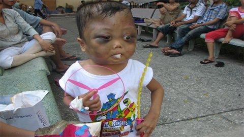 Mỗi lần cháu khóc máu chảy tràn qua lỗ mũi...