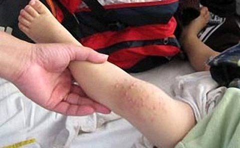 Một tuần thêm 1.500 ca mắc tay chân miệng