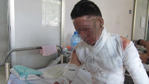 Đi ăn lẩu, vợ chồng trẻ bị bỏng nặng