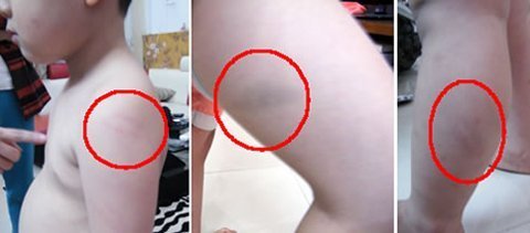 Bé 5 tuổi bị cô đòn roi tím khắp người