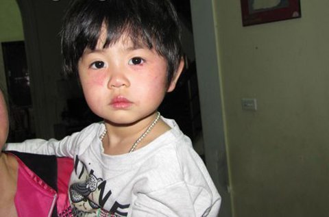 Cô mầm non vụt thước vào mặt bé 2 tuổi