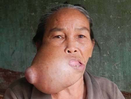 Mặt một cụ bà ở Bình Định bị biến dạng quái ác