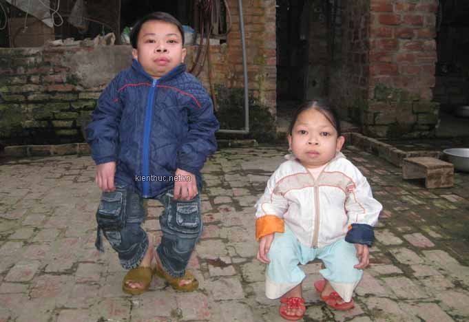 Căn bệnh lạ khiến hai anh em giống ếch