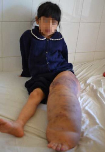 Bé gái lớp 2 mang chân “khủng” 15kg